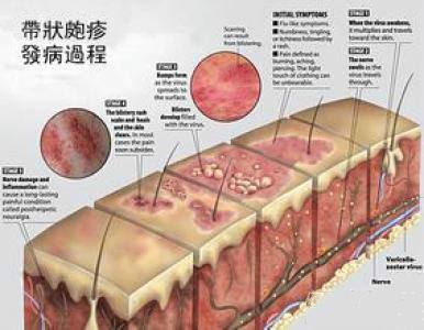 老人脖子疼误诊为颈椎病 罪魁祸首竟是带状疱疹